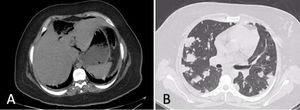A) Abdominal CT scan showing a ruptured liver abscess. B) Chest CT scan showing multiple bilateral cavitated nodules.
