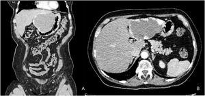 The arterial phase of triphasic computed axial tomography showing the hemangioma in segments II and III, measuring 95 × 98 × 90 mm. (A) Coronal view. (B) Axial view.