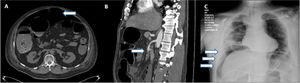 (A) CT scan showing pneumoperitoneum (arrow). (B) CT scan showing superior mesenteric artery thrombosis (arrow). (C) Chest X-ray showing subdiaphragmatic air (arrows).
