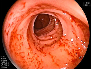 Patchy erosions with marked friability of the colonic mucosa.