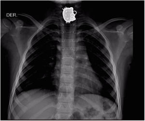Metallic object in the upper third of the esophagus.