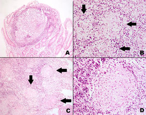 A) Pseudopolypoid lesion in the small bowel. The formation of a nodule can be seen, with a central accumulation of histiocytic cells and a periphery of lymphocytes (H&E ×100). B) Small bowel with histiocytic clear cells, grouped and organized with a tendency to form microgranulomas (arrows) (H&E ×200). C) Small bowel with multiple solid granulomas (arrows) and diffuse lymphocytic infiltrate (H&E ×100). D) Solid granuloma in the small bowel, with multinucleated giant histiocytic cells and clear cytoplasm (H&E ×200).