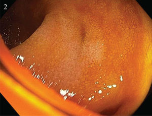 The terminal ileum with 2 small diverticula, with no signs of complications.