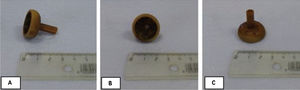 Photograph showing a round foreign body, 2 cm in diameter, corresponding to the internal bumper of a percutaneous endoscopic gastrostomy tube.