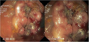 Rectal retroflexion image, showing eccentric and ulcerated lesion in the anal verge.