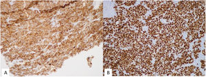 Immunohistochemistry: A) Positive cytoplasmic staining for Melan-A (x40). B) Positive nuclear staining for SOX-10 (x20).