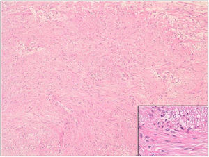 Fusiform cells with an orthogonal fascicular distribution, with the presence of numerous mastocytes and the absence of mitosis, atypia, and necrosis.