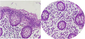 Histologic slides showing the colonic mucosa. Abundant mixed inflammatory cells can be seen in the lamina propria, as well as in the epithelium of the glands and crypts, with an important quantity of eosinophils (up to 50 per high power field), consistent with eosinophilic colitis (courtesy of Dr. Claudia Peña Zepeda).
