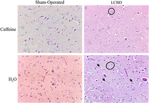 Photomicrographs of encephalon sections stained in hematoxylin-eosin. (magnification, x400). Alzheimer type II astrocytes (under the black stars), necrosis (black arrows), edema (white halo around the cells), and spongiform aspect can be observed in a moderate/accentuated degree in the LCBD + H2O group. The LCBD+CAF group showed significant improvement in those characteristics. The control groups had normal histology. CAF: caffeine; LCBD: ligation of the common bile duct.