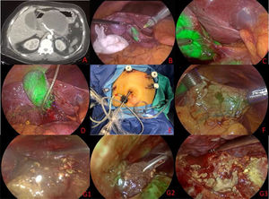 A) Contrast-enhanced abdominal tomography scan. B) Intravesicular application of indocyanine green. C) Identification of the structures of the hepatocystic triangle. D) Intraoperative cholangiography. E) Positioning of the trocars. F) Transgastric trocars after intravenous injection of indocyanine green. G1-G3) Transgastric necrosectomy.