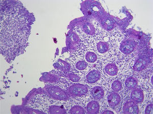 Histopathologic study of the colonoscopy biopsies showing the mucosa of the cecum with edema and tubular glands with fibrinous exudate on the surface.