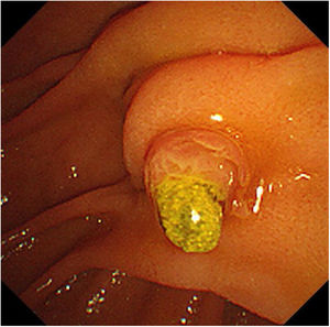 Endoscopy showed that the ampulla of Vater was slightly enlarged and a gallstone was impacted, presenting the “laying-an-egg” sign.