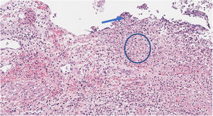 Microscopic image (×40 magnification). Necrosis of the superficial cylindrical epithelium (arrow) with preserved muscle layer and increase in the polymorphonuclear leukocyte infiltration, with transmural extension (circle).