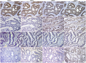 Mismatch repair system profile in colorectal carcinoma (every line is a case). Positive nuclear reaction of all enzymes was observed in the pMMR tumors (A–D). The absence of 2 proteins (MLH-1/PMS2 or MSH6/MSH2) in line 2 (E, F) and line 3 (K, L) or the absence of 3 proteins (line 4; M–O) characterized the dMMR tumors. All are immunohistochemical reactions ×200.