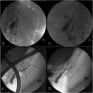 Endoscopic retrograde cholangiopancreatography (ERCP). Cholangiography carried out through the “T” tube, with water-soluble contrast medium. A and B) Entrance of contrast medium with opacification of the gallbladder, in a central anatomic position, slightly to the left of the midline. C and D) Cystic gallbladder containing stones and intrahepatic bile duct located on the left, with no alterations, no signs of biliary filling defects, and with adequate passage of the contrast medium into the duodenum.