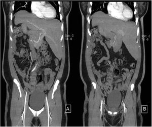 Magnetic cholangioresonance, showing different slices. A and B) Gallstones, catheter in the gallbladder, and abdominal situs inversus totalis are identified.