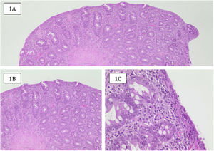 Histologic sample from a female patient in the case series classified as Marsh 3b. A) Duodenal mucosa with a flat surface (absence of villi), with hyperplastic crypts (hematoxylin/eosin [H&E] ×4). B) Crypt hyperplasia and enlarged inflammatory infiltrate in the lamina propria (H&E ×10). C): Inflammatory infiltrate rich in plasma cells of the lamina propria, epithelial surface reduced in height, mucinous content, and numerous lymphocytes in its interior (H&E, ×40). Source: Dr. Laura Carreño T.