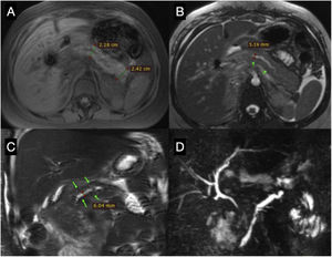 Magnetic resonance cholangiography. (A) T1-weighted axial view, showing the enlarged body and tail of the pancreas. (B) T2-weighted axial view, showing the body of the pancreas, with irregular dilation of the main pancreatic duct. (C) T2-weighted coronal view, showing the dilation of the main pancreatic duct. (D) MIP reconstruction of the cholangiopancreatography, showing irregular dilation of the main pancreatic duct and normal intrahepatic bile ducts.