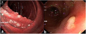(a) Duodenum with whitish nodular mucosa. (b) Ulcer in the distal ileum.