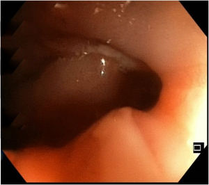 Endoscopic image of the stricture observed during the examination.