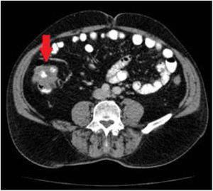 Chest and abdominal CT scan showing the wall thickening of the ascending colon (arrow).
