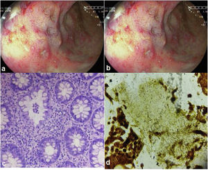(a) Multiple rectal ulcers. (b) Rectal ulcer with raised edge and clean base. (c) H&E staining showing the lymphoplasmacytic infiltrate and cryptic abscess. (d) Warthin–Starry staining showing multiple spirochetes.