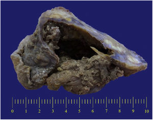 Macroscopic aspect of the inflammatory lesion, showing its irregular and heterogeneous shape, with central cavitation (the numbers on the measuring scale are in centimeters).