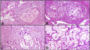 (A–B) At medium magnification, the irregular accumulation of hyaline material surrounded by connective tissue and inflammatory cells can be seen (hematoxylin and eosin ×100). (C) Granulomatous inflammation with foreign body giant cells is identified in other areas (hematoxylin and eosin ×100). (D) At a higher magnification, the hyaline material can be seen to form acellular and eosinophilic ring-like structures (hematoxylin and eosin ×400).