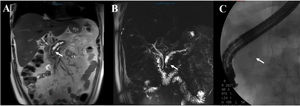 (A and B) Magnetic resonance cholangiography showing main pancreatic duct dilation up to 8 mm, with a serpiginous tract and sudden caliber reduction at the level of the head of the pancreas, associated with an intraluminal hypointense image (arrow). (C) Fluoroscopy showing a radio-opaque stone in the topography of the head of the pancreas (arrow).