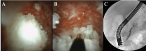 (A) Image of the intraductal pancreatic stone seen with the Spyglass™ system. (B) Intraductal electrohydraulic lithotripsy. (C) Fluoroscopy showing the removal of residual fragments with the extraction balloon.