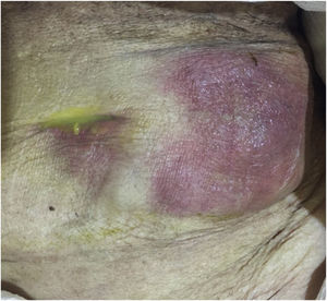 Anterior wall of the abdomen, with the presence of exudate.
