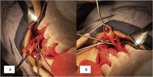 A, B) Images showing the cystic duct (approximately 5 mm), bile duct dilation, and the absence of bile duct stones.
