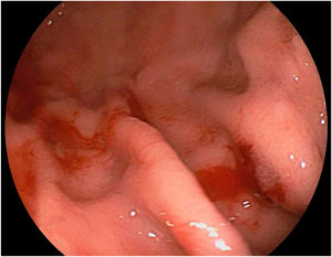 Persistent bleeding after polypectomy.