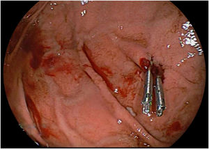 Mechanical hemostasis of the bleeding, with the placement of 2 endoclips.