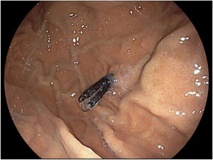 Endoscopic follow-up 2 years after endoclip placement.