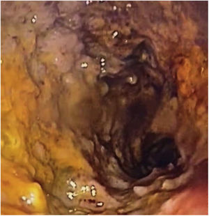 Edematous mucosa with a nodular pattern, erythema, and ulcers of the duodenal bulb can be seen.