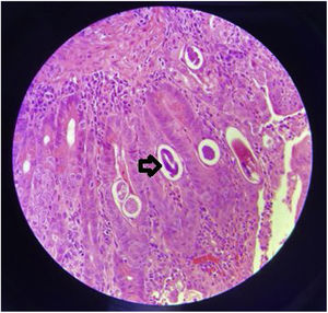 Fragments of Strongyloides stercoralis larvae (arrow).