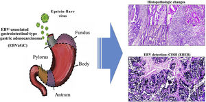 Graphical summary. Epstein-Barr virus (EBV) infection is an etiologic factor in EBV-associated gastric cancer (EBVaGC). That type of cancer is differentiated by a histologic lace pattern, characterized by the connection and fusion of neoplastic glands. Those histopathologic parameters facilitate the selection of cases that are candidates for molecular studies, such as in situ hybridization, which could contribute to the understanding of the disease and be useful in the evaluation of clinical and pathologic determining factors in regions with a high incidence of gastric cancer.