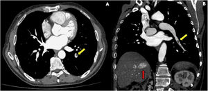 Computed tomography scan in the arterial phase. Yellow arrows show partial filling defects in the segmental arterial branches in the lower lobe of the left lung, corresponding to pulmonary embolism. There is no evidence of pulmonary metastasis. The red arrow reveals tumor thrombi within the right hepatic vein. (A) Transverse plane; (B) Coronal plane.