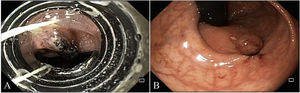 A) Band ligation application. B) Post-band ligation view of Dieulafoy’s lesion.