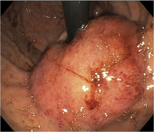 Tumor in the cardia extending into the inferior third of the esophagus, seen by retroflexion during upper endoscopy.
