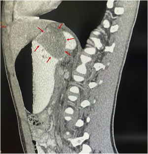 Sagittal view of a computed tomography scan, with oral and intravenous contrast media, showing a cardia-dependent tumor occupying the gastric fundus.