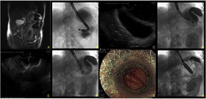 A) Magnetic resonance image showing a stone in the distal third. B) Distension of the excluded stomach seen through fluoroscopy. C) Endoscopic ultrasound (EUS) view of both gastric walls. D) 19G FNA puncture of the gastric remnant to the excluded stomach and advancement of the 0.035″ hydrophilic guidewire into the antrum of the excluded stomach. E) EUS image of the Hot AXIOS™ lumen-apposing stent placement. F) Fluoroscopic image of the placement. G) Endoscopic image of the gastrojejunal anastomosis. H) 18mm CRE™ balloon dilation of the anastomosis through the body of the stent.