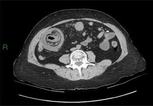 Abdominal CT scan showing an ileocecal intussusception.