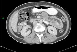 Abdominal CT scan showing an enteroenteric intussusception.