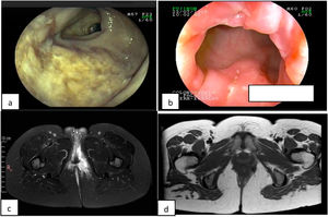 a) Deep ulcer in the terminal ileum at disease onset. b) Deep anal fissures. c) Magnetic resonance imaging showing perianal abscess. d) Resolved abscess.