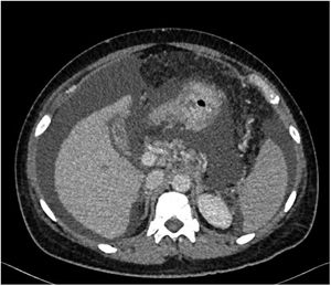Axial abdominal CT image with intravenous contrast enhancement. Indirect signs of portal hypertension can be seen (collateral circulation with perisplenic and perigastric varices, mild splenomegaly, important hydropic decompensation, with abundant ascites in all compartments), with a homogeneous liver parenchyma showing no signs of advanced chronic liver disease or focal lesions.