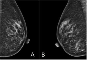 Radiologic mammogram images of the left breast (A) and right breast (B). There is symmetry between the two breasts, with adequate distribution of the glandular tissue, and no distortions in the architecture or suspicious calcifications. The skin and nipple complex are unaltered.