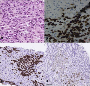 Histologic images of the liver and stomach biopsies (×20). (A) Liver biopsy slide with hematoxylin and eosin stain, showing a diffuse infiltrate of neoplastic cells at the level of the portal vein and periportal sinusoid spaces. (B) Liver biopsy slide with immunohistochemistry techniques, showing infiltration into the liver parenchyma by tumor cells positive for GATA-3. (C) Liver biopsy slide with immunohistochemistry techniques, showing infiltration into the liver parenchyma by tumor cells positive for cytokeratin 7. (D) Stomach biopsy slide with immunohistochemistry techniques, showing infiltration into the gastric mucosa by tumor cells positive for estrogen receptors.