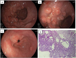 (A) Gastric body showing giant hypertrophic folds. (B) Folds with mucus secretions. (C) Gastric antrum with erosions. (D) Histologic study showing marked foveolar hyperplasia and cystic dilations.